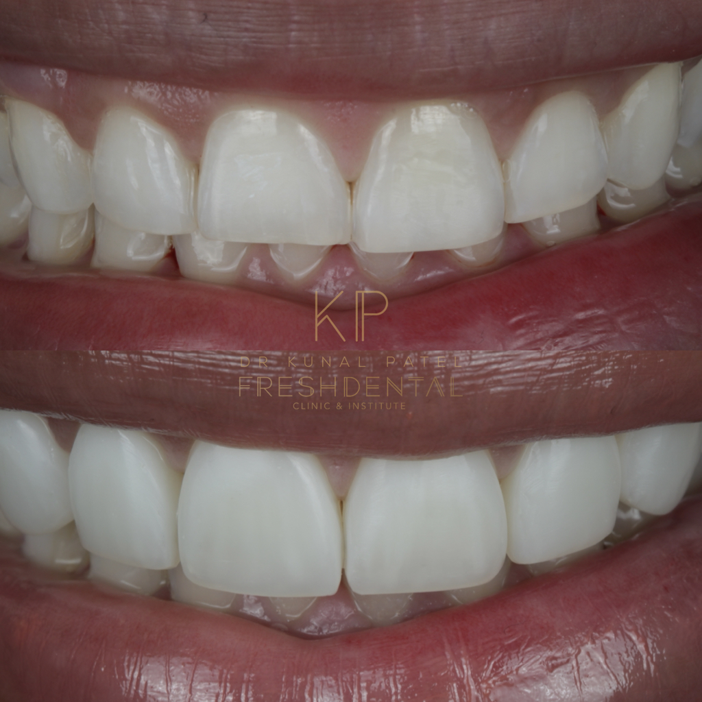 Before and after composite bonding by Dr Kunal Patel