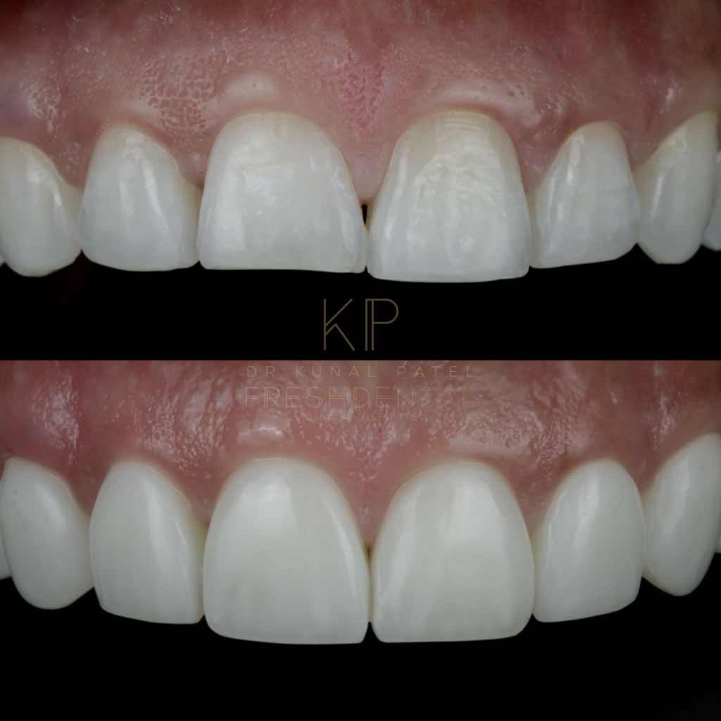 Before and after veneers by Dr Kunal Patel