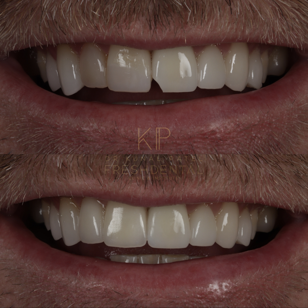 Before and after crowns and bonding by Dr Kunal Patel