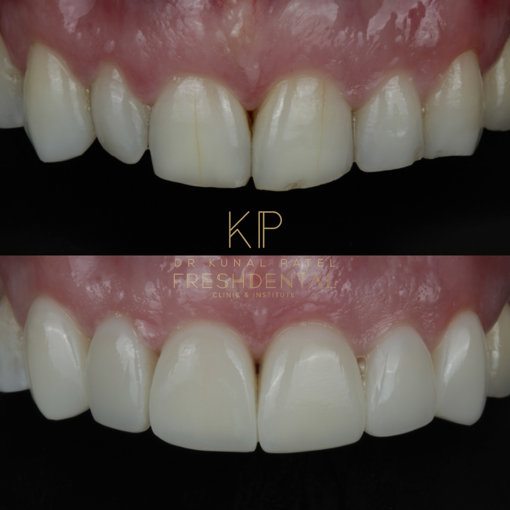 Before and after composite bonding by Dr Kunal Patel