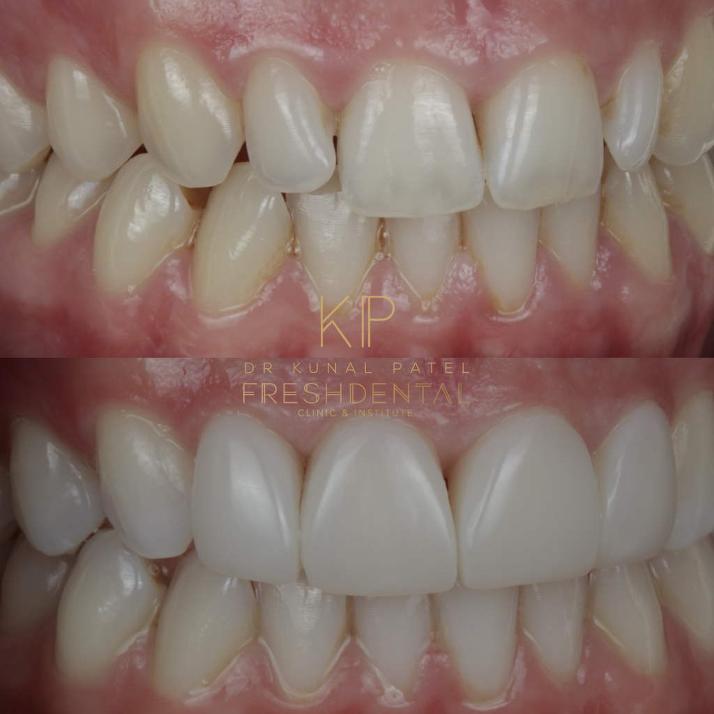 Before and after smile makeover by Dr Kunal Patel
